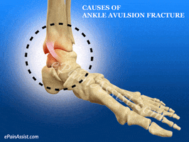 causes of ankle avulsion fracture GIF by ePainAssist