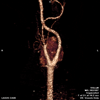 heart ct GIF by Medical Imaging & Technology Alliance
