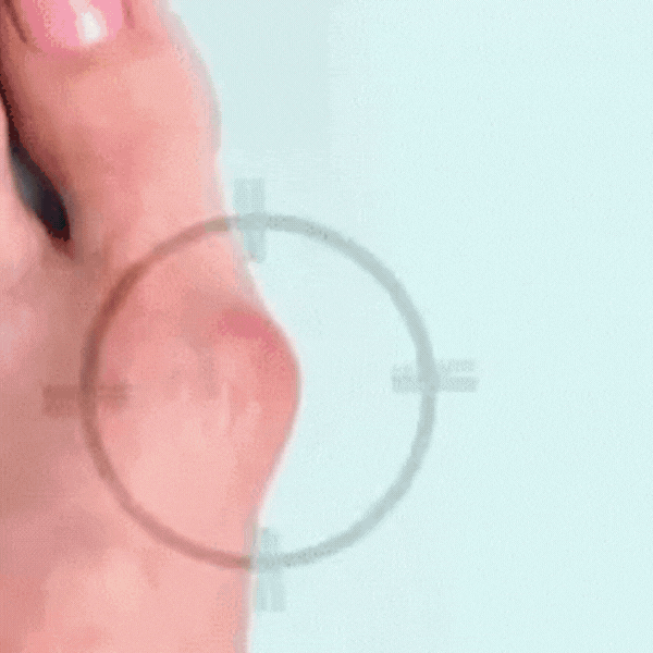 Hallux Valgus GIF