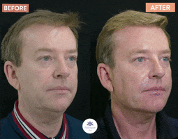 Therapieclinic tv after botox before GIF