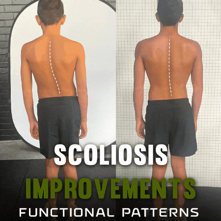 Scoliosis GIF by functionalpatterns