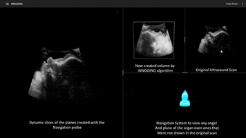 GIF by iNNOGING Medical