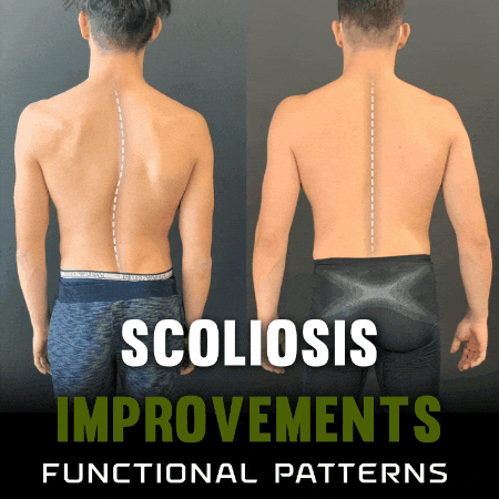 Scoliosis GIF by functionalpatterns