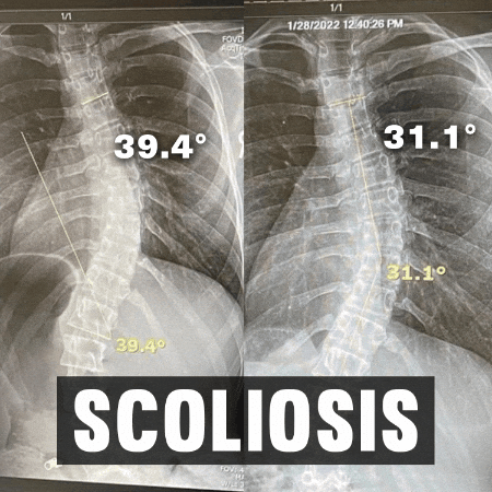 Scoliosis GIF by functionalpatterns