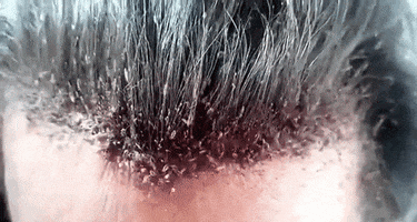 lice scalp GIF