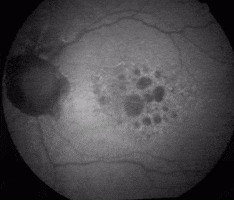 Atrophic Amd Progression GIF