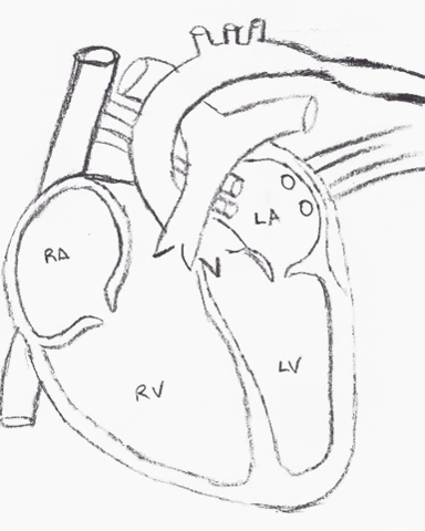 Heart Defect Coarction Of The Aorta GIF