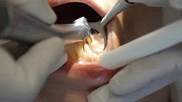 sonriemanta teeth dentist odontologia process GIF