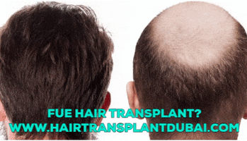 Fue Hair Transplant GIF
