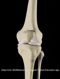 Knee-replacement GIFs - Get the best GIF on GIPHY