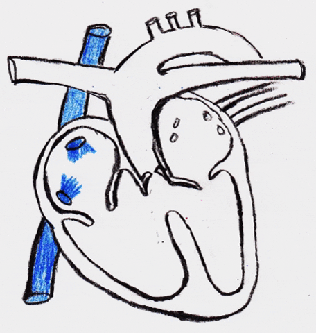 Congenital Heart Defects Truncus Arteriosus GIF