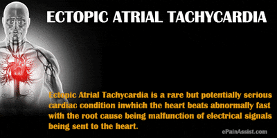 what is ectopic atrial tachycardia? GIF by ePainAssist