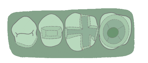 Overlay Inlay Sticker