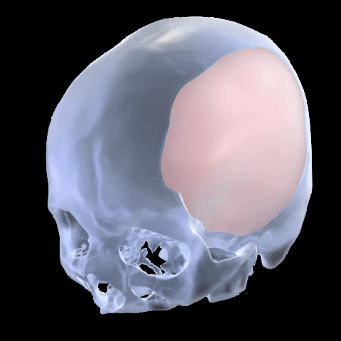 baioone implant baio calota cranioplastia GIF