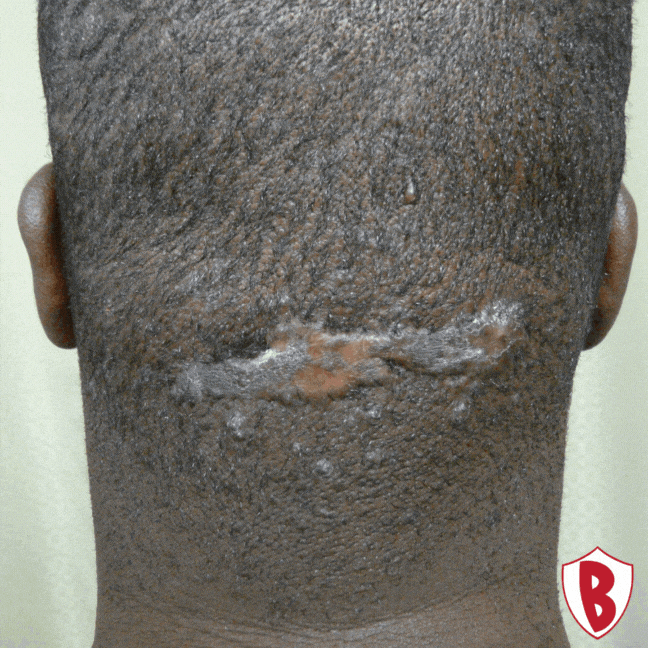 Before And After Transformation GIF by Dr. U Hair and Skin Clinic