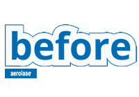 Acne Treatment Sticker by Aerolase