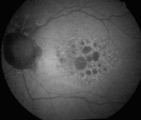 StephenSinclair giphygifmaker atrophic amd progression GIF