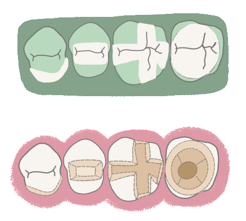 Overlay Inlay Sticker