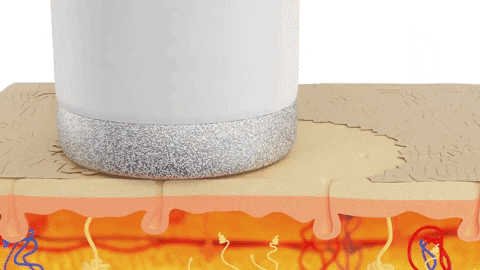 trophyskinOFFICIAL giphygifmaker exfoliate microdermabrasion trophyskin GIF