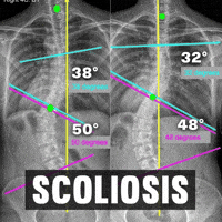 Scoliosis GIF by functionalpatterns