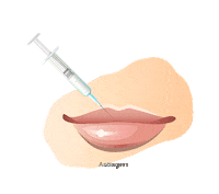 Lips Surgery Sticker by Antiagers