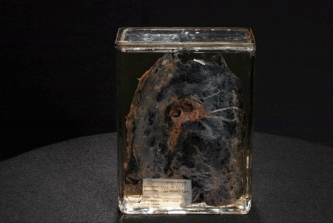 lung blacklungdisease GIF by Mütter Museum