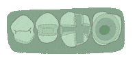 Overlay Inlay Sticker