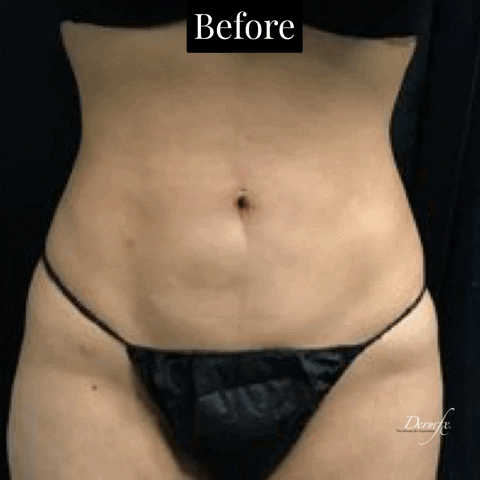 GIF by DermFx