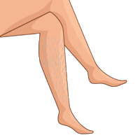 Laserhairremoval Sticker by TiamSpa