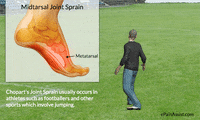 which are the ligaments that get injured in midtarsal joint sprain? GIF by ePainAssist