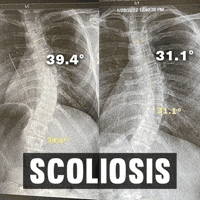 Scoliosis GIF by functionalpatterns