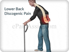 Lower Back Discogenic Pain GIF by ePainAssist.com
